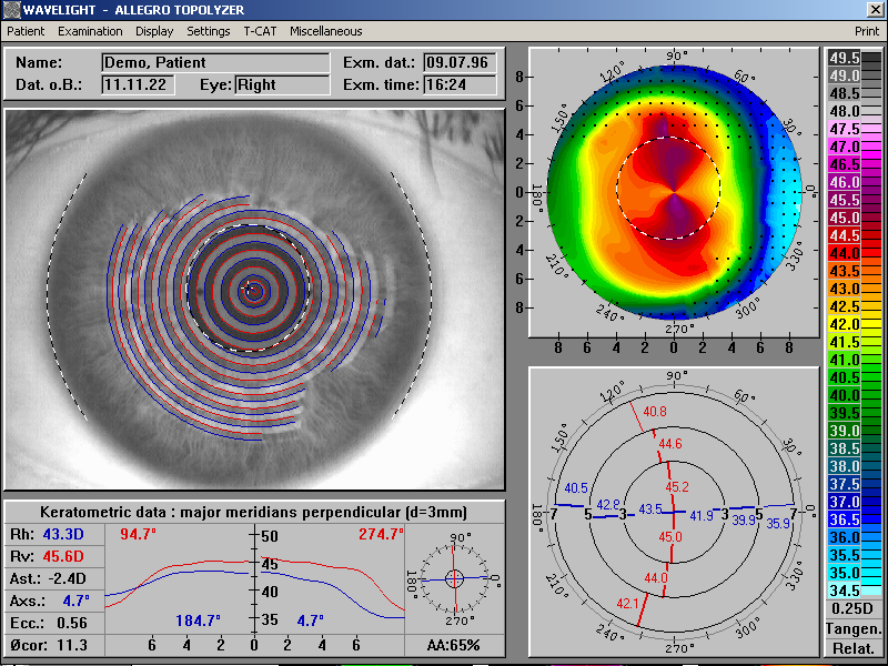 ALLEGRETTO Wave Eye-Q: интерфейс топографического планирования ALLEGRO Topolyzer